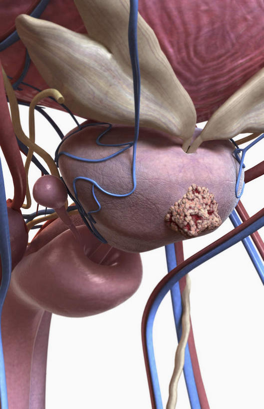 无人,竖图,插画,室内,特写,白天,白色背景,正面,数码,科技,静物,阴影,网络,医学,高光,几何,计算机图形,合成,图画,画,人体,电脑合成图,数码合成图,疾病,生物学,肿瘤,漫画,泌尿系统,前列腺,癌症,生理学,写实,具体,具象,恶性肿瘤,前列腺癌,彩图