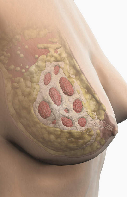 胸,无人,竖图,插画,室内,特写,白天,正面,数码,科技,静物,阴影,黑色背景,网络,医学,高光,几何,计算机图形,合成,图画,画,人体,电脑合成图,数码合成图,生物学,肿瘤,乳腺癌,漫画,癌症,生理学,写实,具体,具象,肿瘤细胞,女性,胸部,彩图