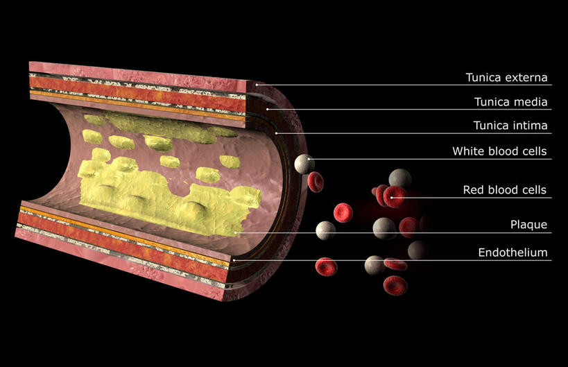 血管,无人,横图,俯视,插画,室内,白天,数码,科技,阴影,黑色背景,过程,网络,医学,材料,高光,几何,计算机图形,合成,图画,画,红色,电脑合成图,数码合成图,疾病,生物学,漫画,进程,原料,生理学,写实,具体,具象,动脉硬化,动脉粥样硬化,血管病,彩图,高角度拍摄