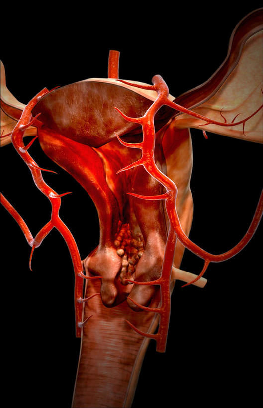 内脏,动脉,静脉,卵巢,子宫,无人,竖图,室内,白天,正面,数码,科技,静物,阴影,黑色背景,网络,医学,高光,几何,计算机图形,合成,红色,模型,人体,电脑合成图,数码合成图,疾病,生物学,人体器官,器官,生理学,写实,具体,具象,子宫癌,彩图,生殖器官,子宫颈癌