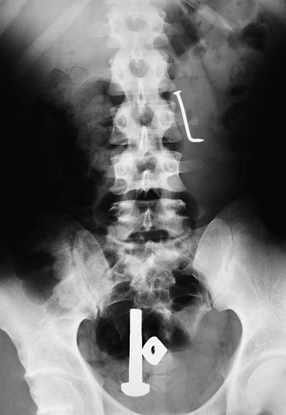脊髓,骨骼,无人,竖图,x光片,室内,特写,白天,正面,静物,黑色背景,辐射,科学,医学,钉子,骨头,一个,单个,骨架,五金,医疗,科学技术,x射线,紧固,x光,牢固,脊柱,彩图,稳固,电磁波,电磁辐射