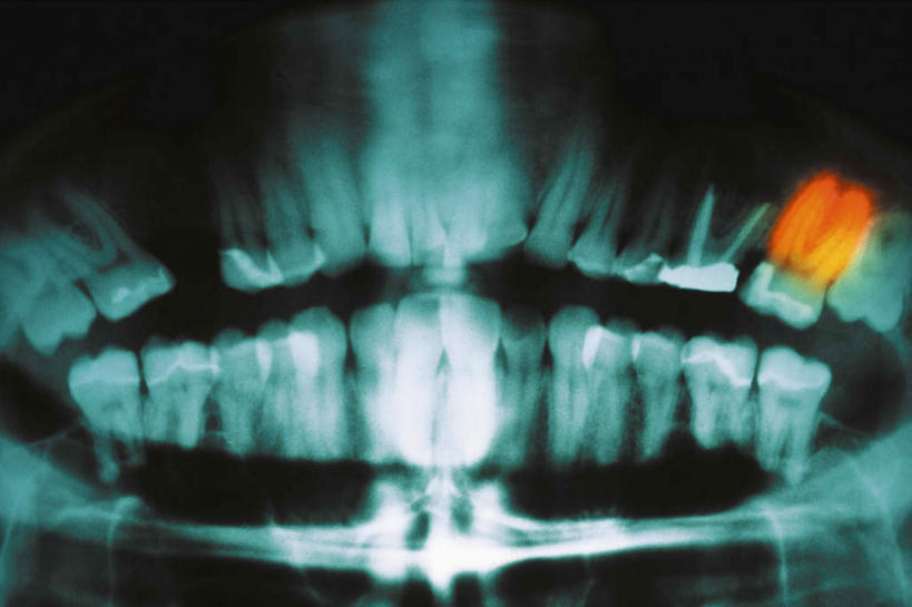 牙齿,无人,横图,x光片,室内,特写,白天,正面,朦胧,模糊,辐射,科学,医学,医疗,科学技术,x射线,x光,齿,牙,牙龈,彩图,电磁波,电磁辐射